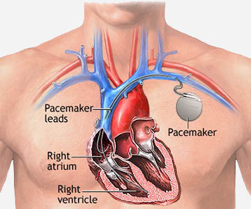 Pacemaker Surgery in Bhagalpur