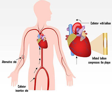 Cath Lab and Angiography or Angioplasty in Bhagalpur