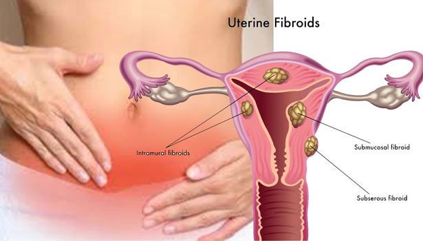 Uterine Related Diseases or Normal Delivery in Bhagalpur